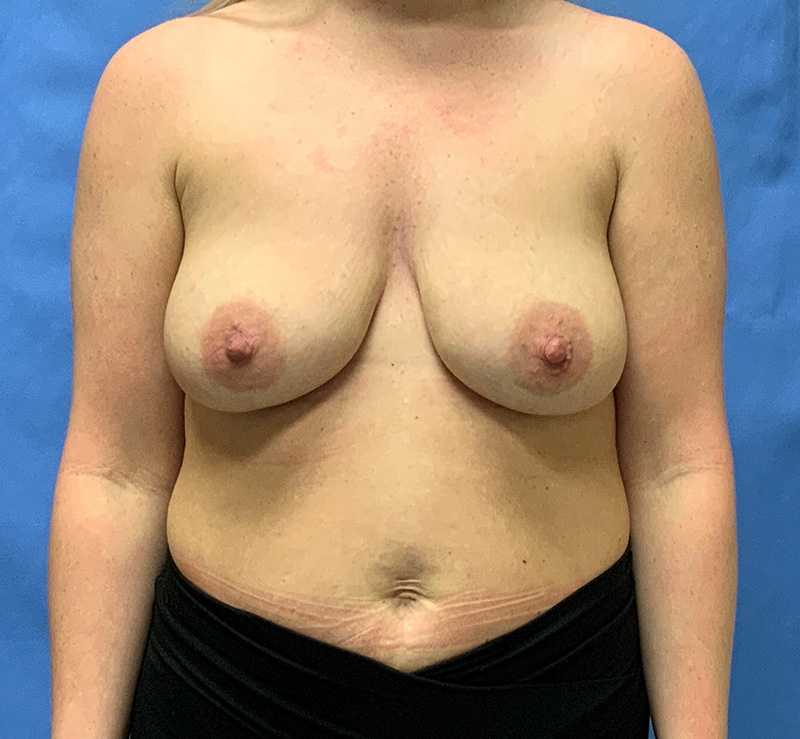 Breast lift Before & After Image
