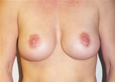 Breast lift Before & After Image