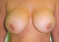 Breast lift Before & After Image