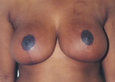 Breast lift Before & After Image