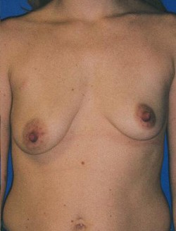 Breast lift Before & After Image