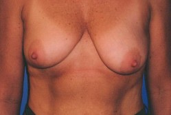 Breast lift Before & After Image