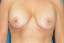 Breast lift Before & After Image