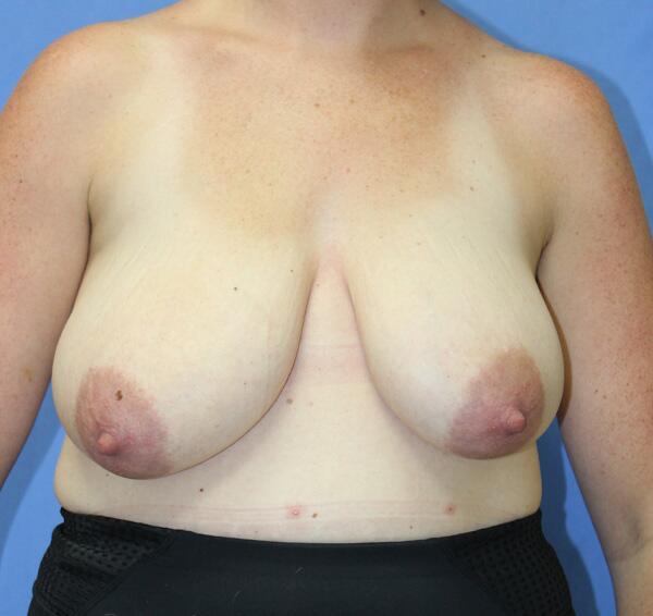 Breast reduction Before & After Image