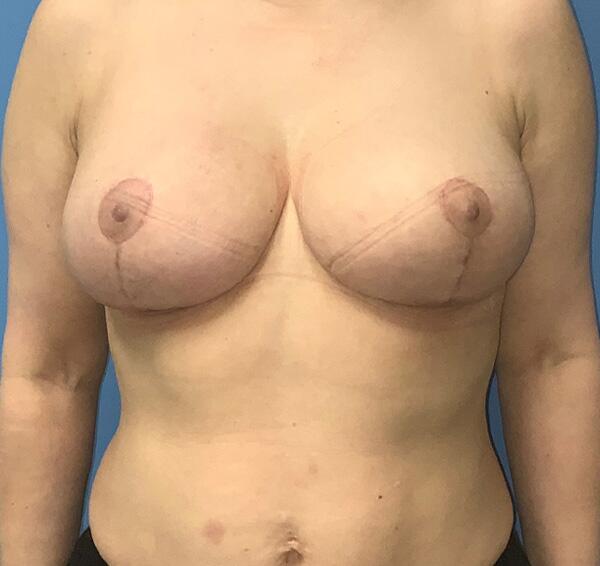 Breast reduction Before & After Image
