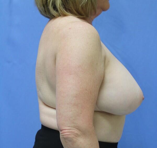 Breast reduction Before & After Image