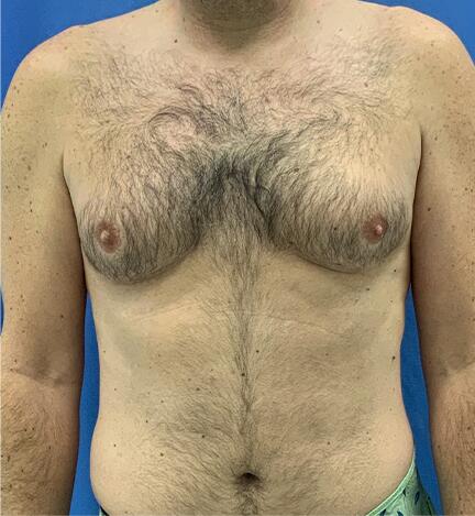 Gynecomastia Before & After Image
