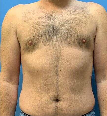 Gynecomastia Before & After Image