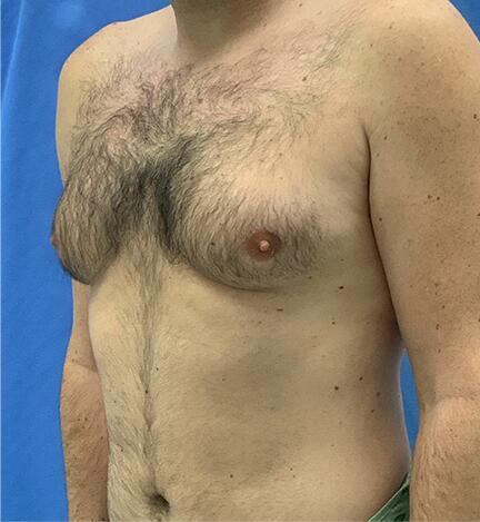 Gynecomastia Before & After Image