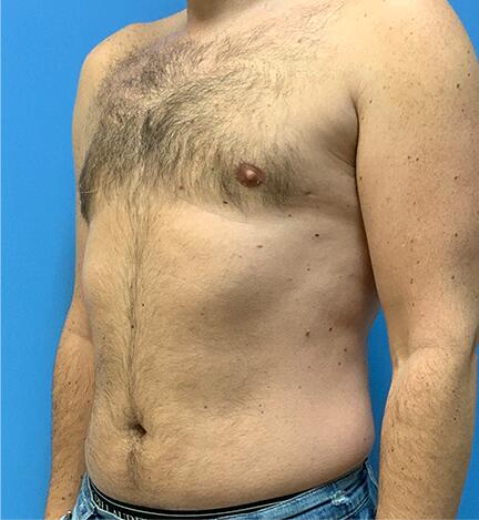 Gynecomastia Before & After Image