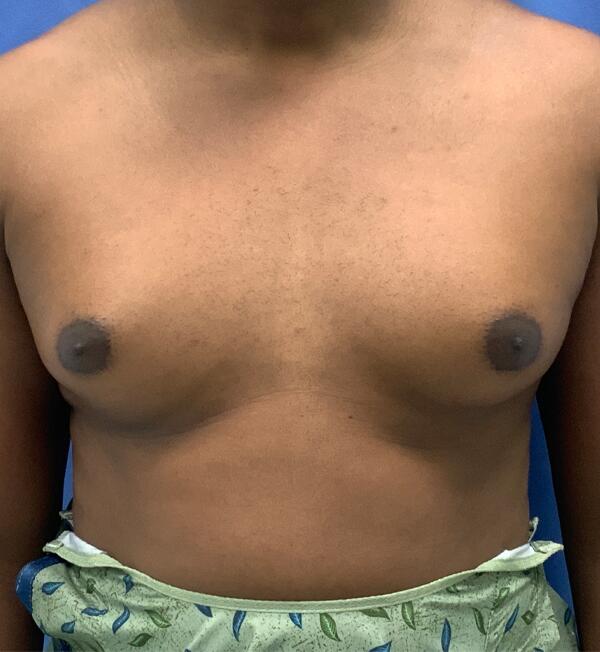 Gynecomastia Before & After Image