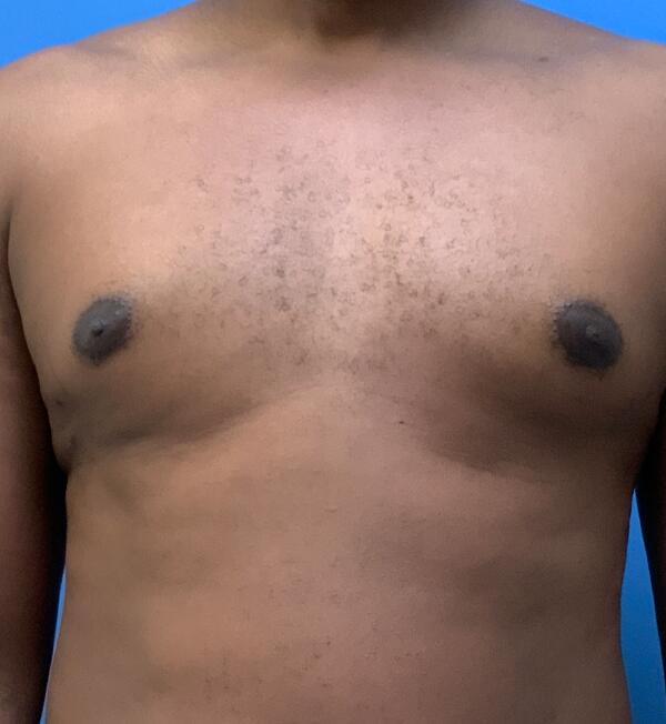 Gynecomastia Before & After Image