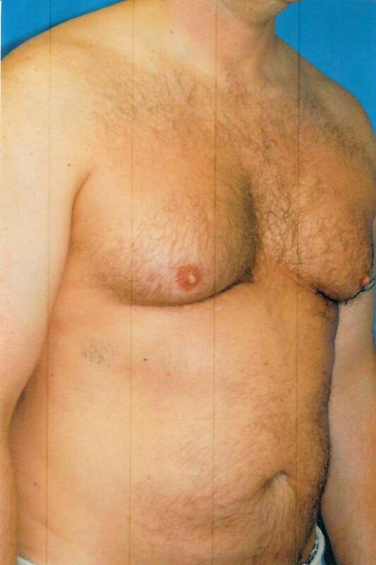 Gynecomastia Before & After Image