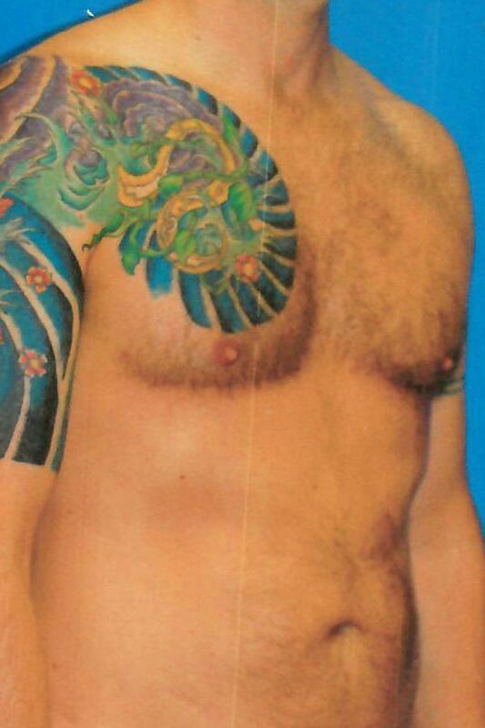Gynecomastia Before & After Image