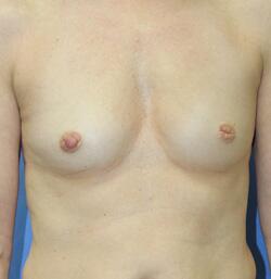 Inverted Nipples Before & After Image