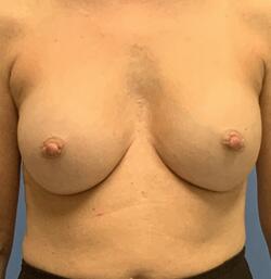 Inverted Nipples Before & After Image