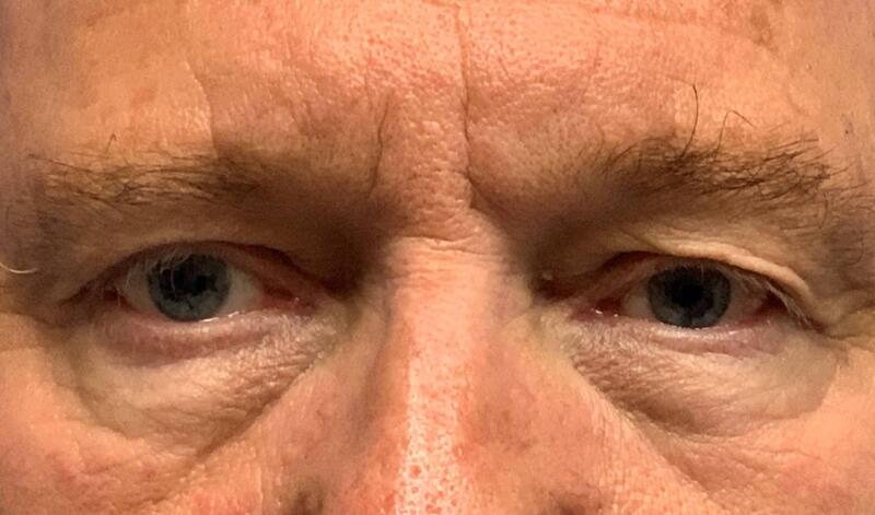 Blepharoplasty Before & After Image