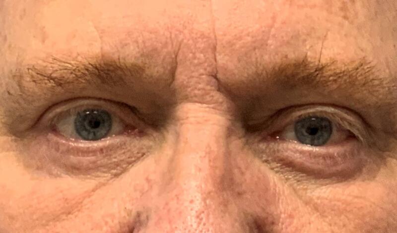 Blepharoplasty Before & After Image