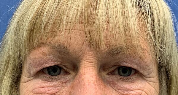 Blepharoplasty Before & After Image