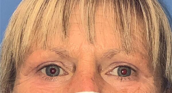 Blepharoplasty Before & After Image