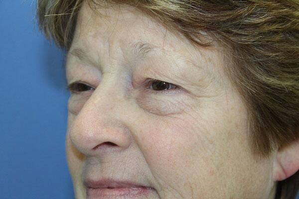 Blepharoplasty Before & After Image