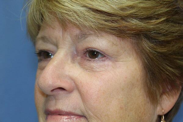 Blepharoplasty Before & After Image