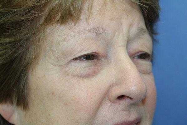 Blepharoplasty Before & After Image