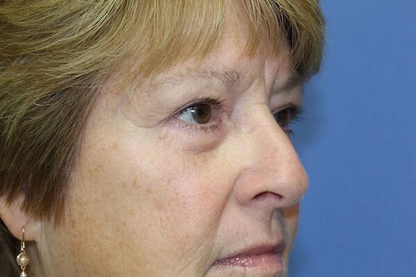 Blepharoplasty Before & After Image