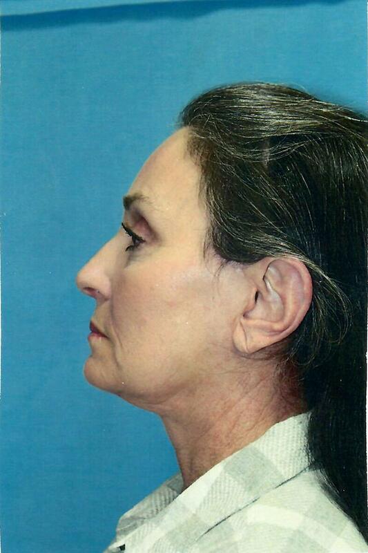 Face lift Before & After Image