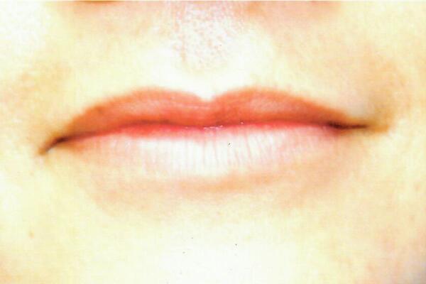 Lip augmentation Before & After Image