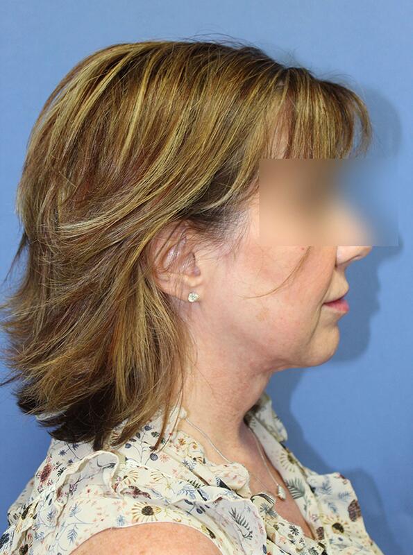 Neck liposuction Before & After Image