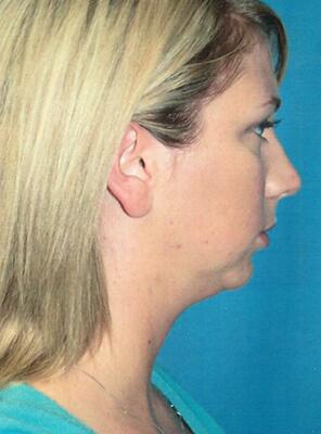 Neck liposuction Before & After Image