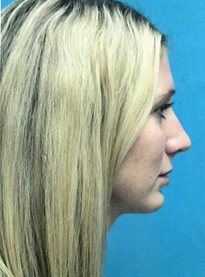 Neck liposuction Before & After Image