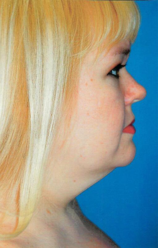 Neck liposuction Before & After Image