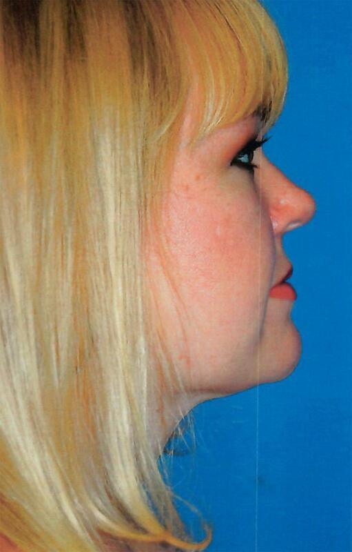 Neck liposuction Before & After Image