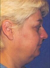 Neck liposuction Before & After Image