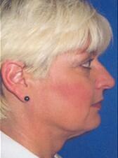 Neck liposuction Before & After Image