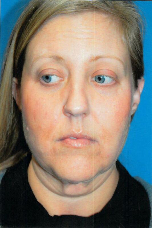 Neck liposuction Before & After Image