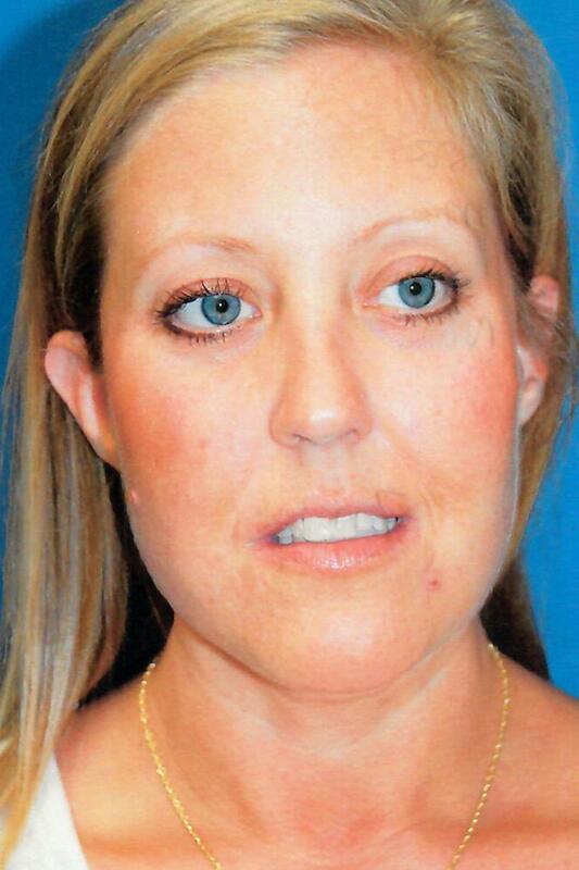 Neck liposuction Before & After Image