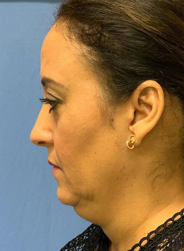 Neck liposuction Before & After Image