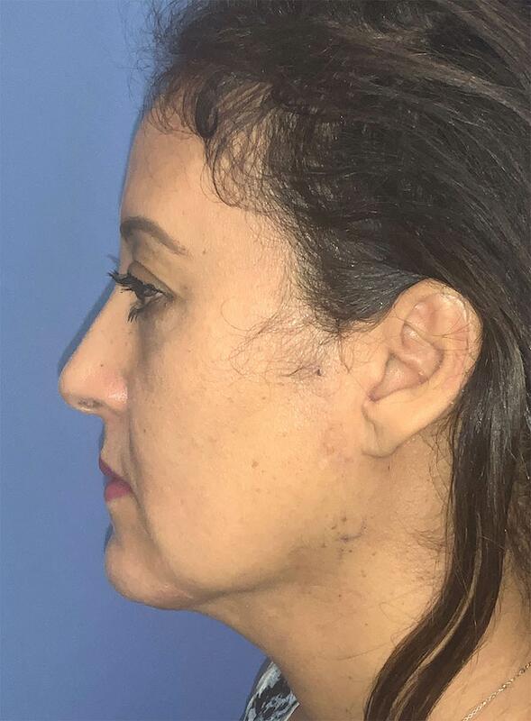 Neck liposuction Before & After Image