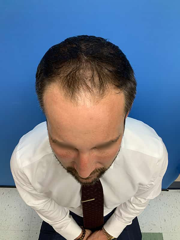 Neograft hair transplant Before & After Image