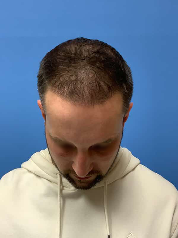 Neograft hair transplant Before & After Image