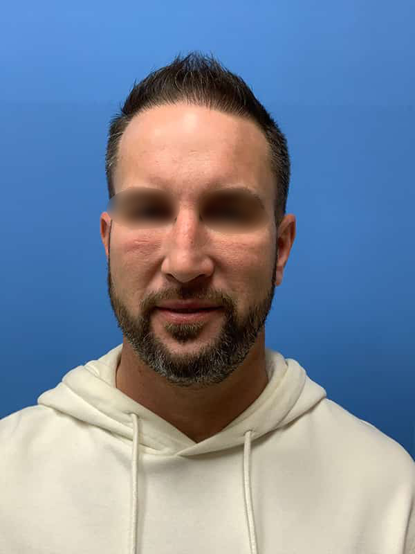 Neograft hair transplant Before & After Image