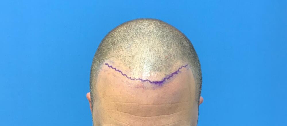 Neograft hair transplant Before & After Image