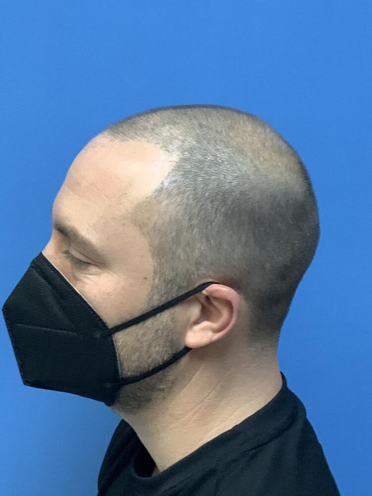 Neograft hair transplant Before & After Image