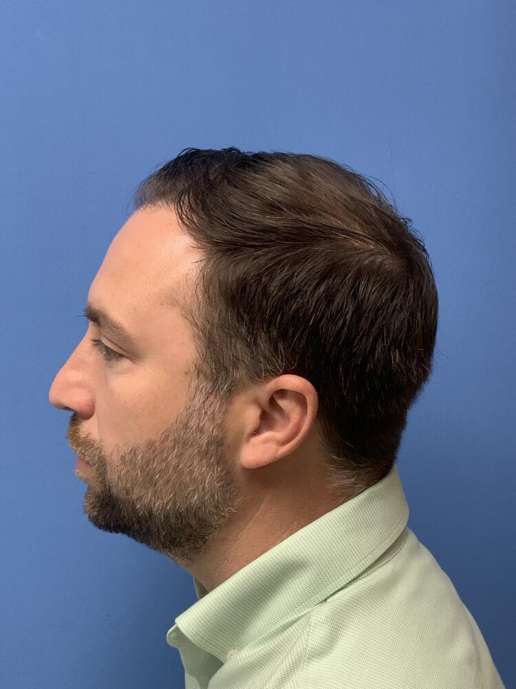 Neograft hair transplant Before & After Image