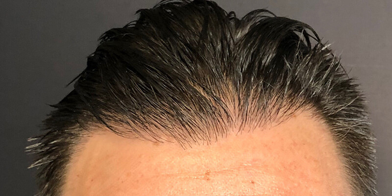 Neograft hair transplant Before & After Image