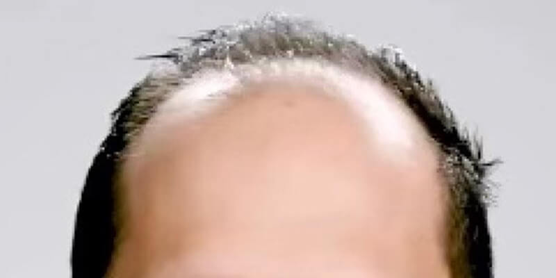 Neograft hair transplant Before & After Image