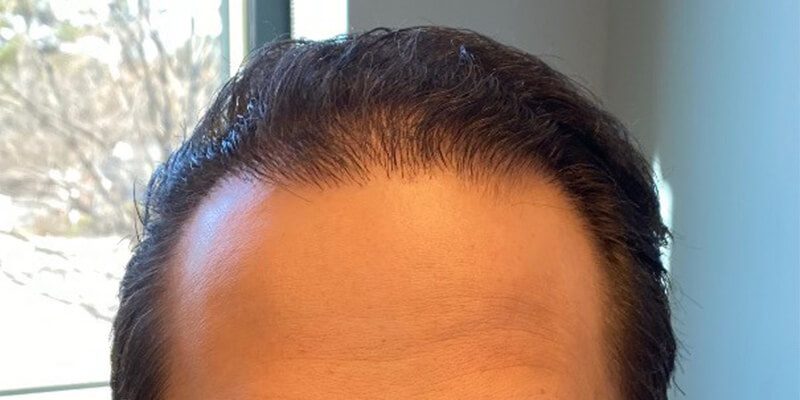 Neograft hair transplant Before & After Image